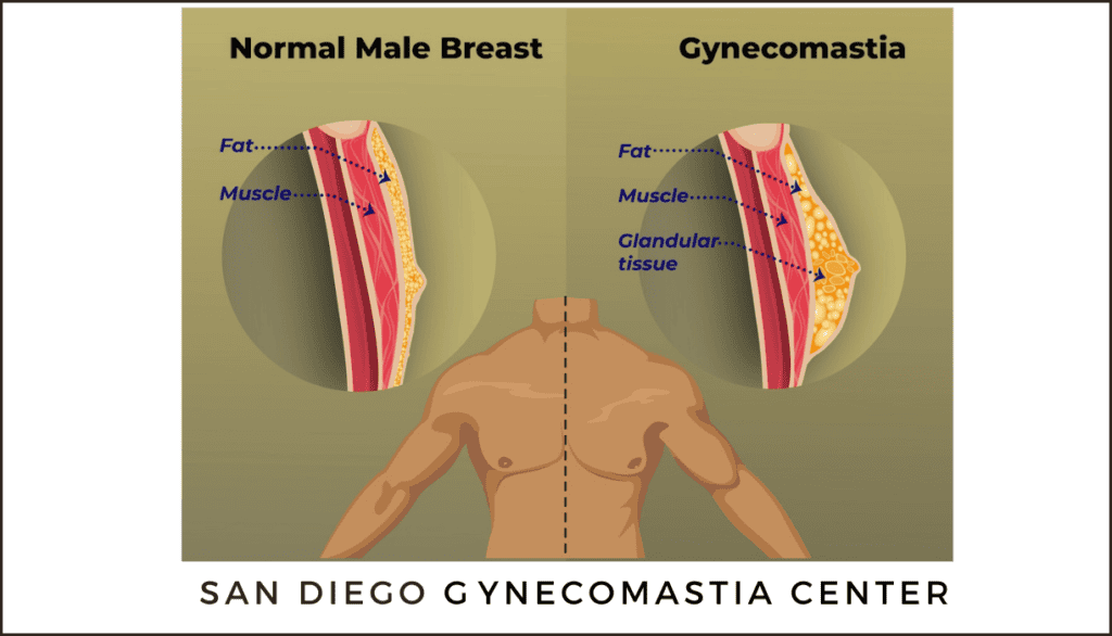 San Diego Gynecomastia
