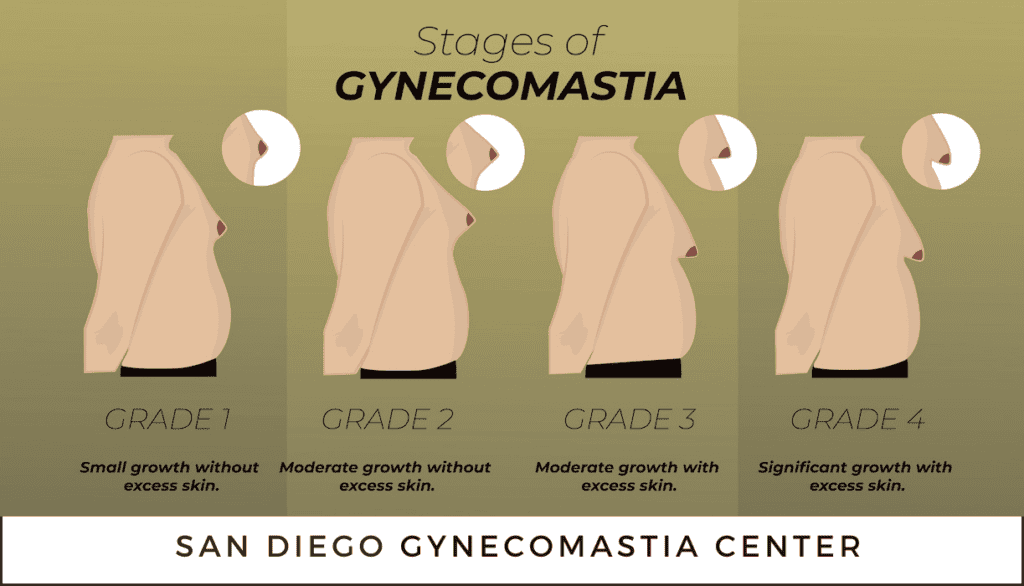 Stages and Grades of Gynecomastia San Diego
